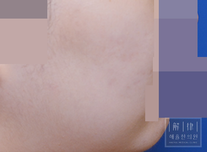 [목동점] 얼굴화농성여드름 치료 후 사진 - 해율한의원